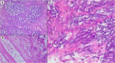 Fatal Early-Onset Aspergillosis in a Recipient Receiving Lungs From a Marijuana-Smoking Donor: A Word of Caution